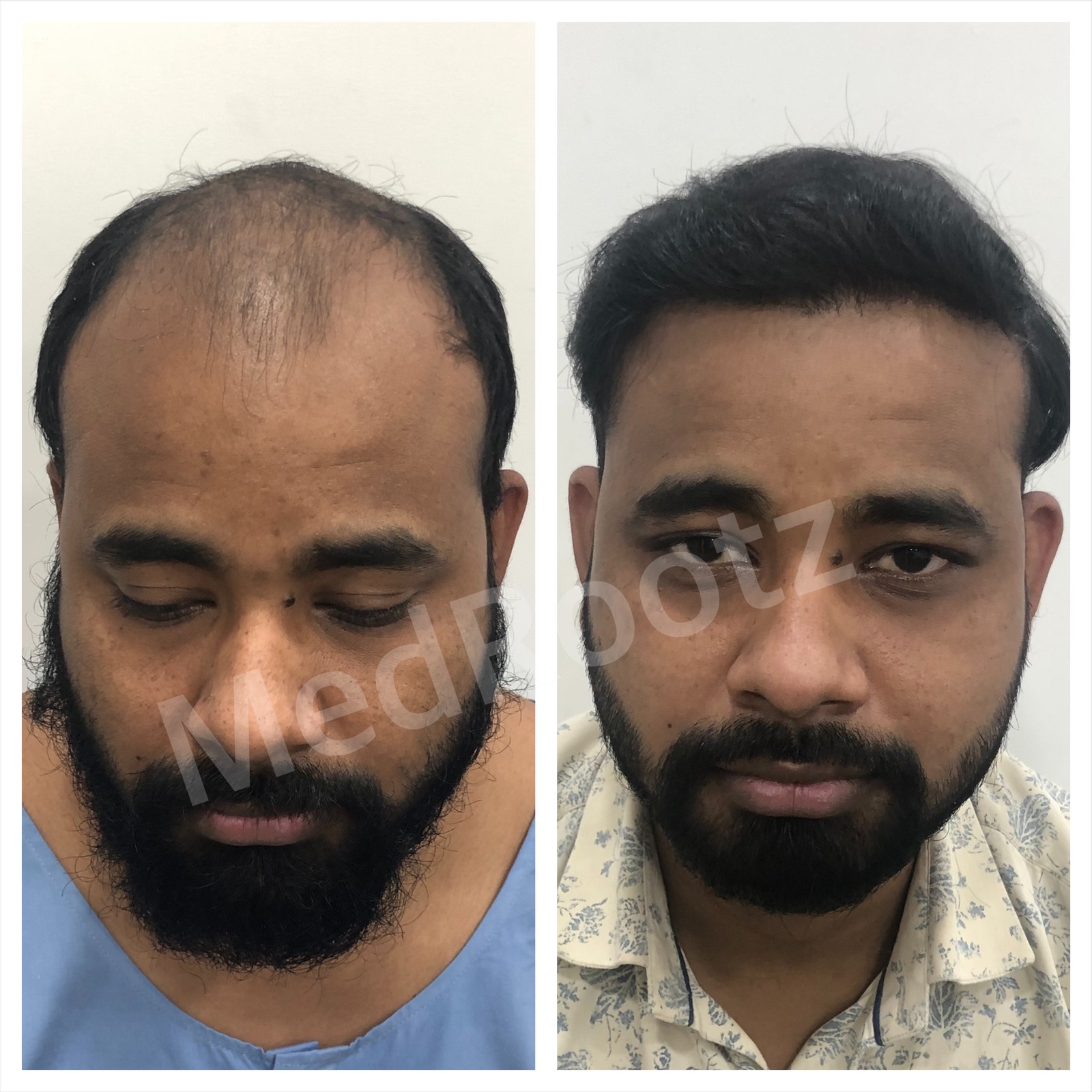 Best hair transplant doctor in delhi